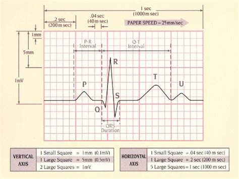 ECG.