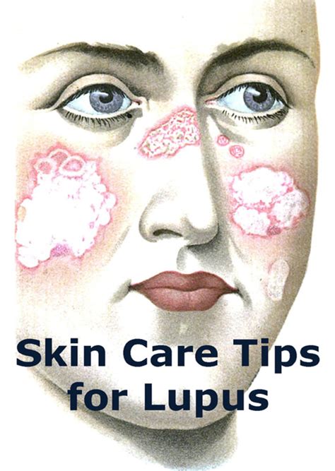 Lupus Skin Care Tips - YouMeMindBody