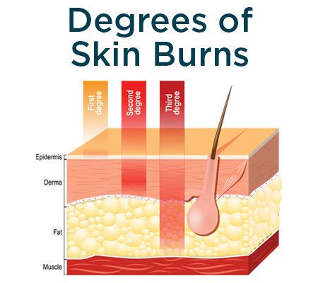 Degree of burns: When should I see a doctor | Shine365