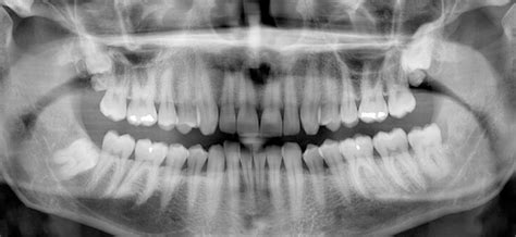 What is a Panoramic X-Ray | Mint Hill Dentistry