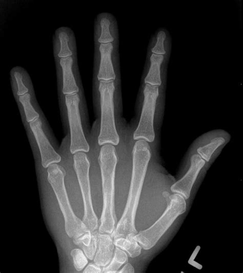 What does hand arthritis look like on x-ray? - John Erickson, MD