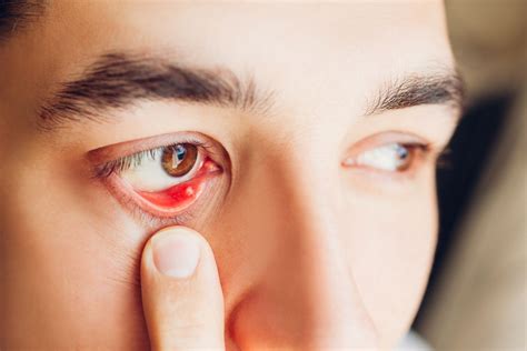 Stye Inside the Eyelid: Symptoms and Treatment