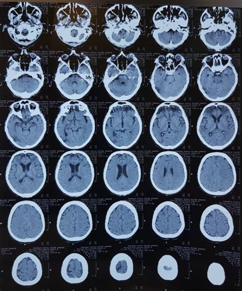 Figure No. 3 -Brain CT scan The results of the chest CT scan (Fig. No ...