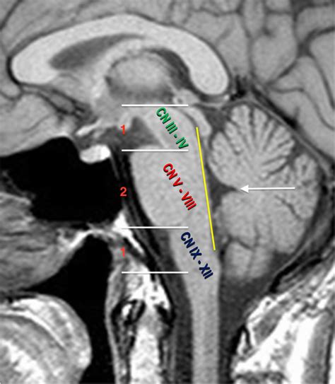 Brain Anatomy Ct Scan Annotated at Consuelo Villarreal blog