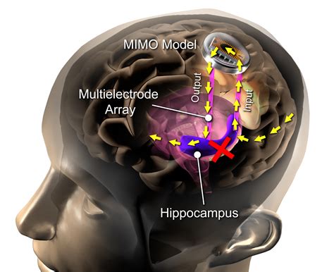 USC researchers develop brain implant to improve memory | Daily Trojan