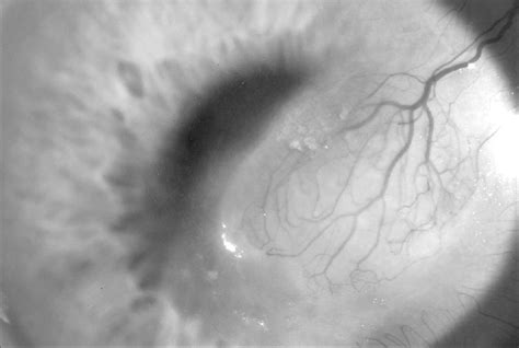 The cornea with a paraxial scar with neovascularization. The patient ...