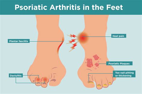 Psoriatic Arthritis in the Feet: Symptoms, Treatment, Home Remedies