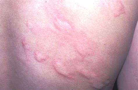 What Allergies Give You Rashes at Jane Hawkins blog