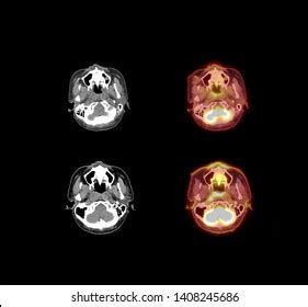 Pet Ct Scan Image Brain Axial Stock Illustration 1408245686 | Shutterstock