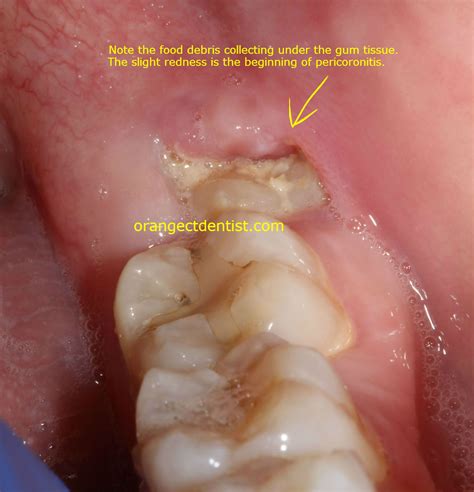 Mouth Infection After Wisdom Teeth Removal - TeethWalls