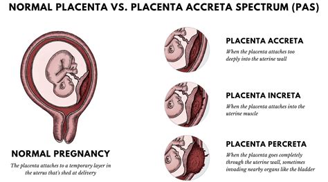 National Accreta Foundation — What is Placenta Accreta Spectrum?