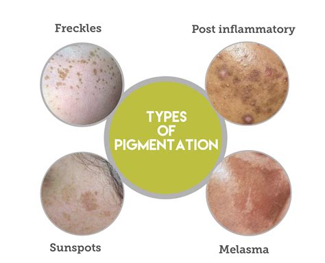 What are the different types of pigmentation? - Jeunesse MedSpa®