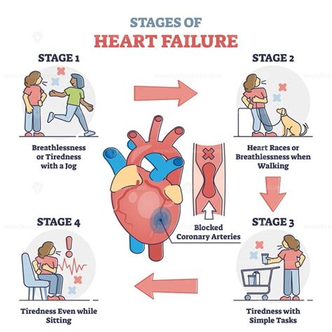 Stages of heart failure and symptoms with cardiology stroke outline ...