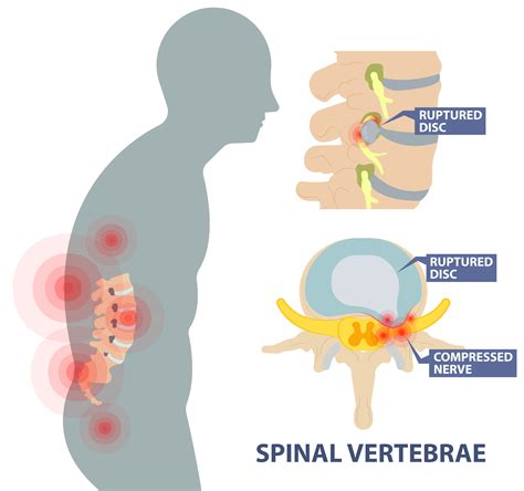 Ruptured Disc Pain & Solutions | AllSpine