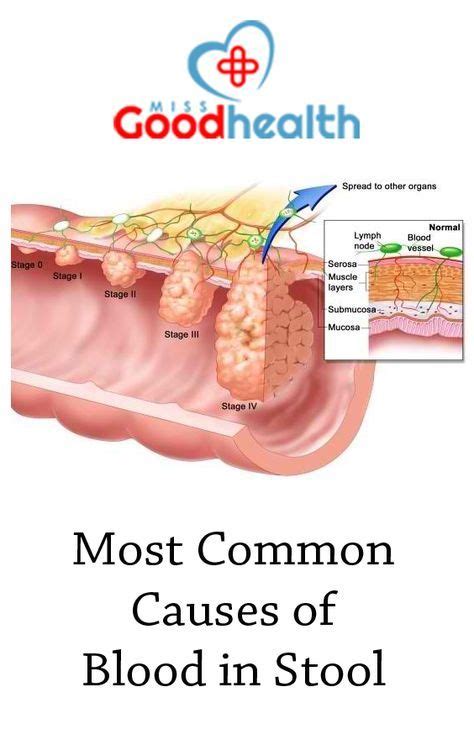 Bestof You: Amazing Blood Streaks In Stool Learn More Here!