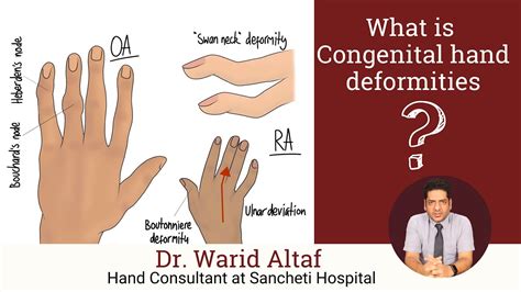 What is Congenital hand deformities & How can we treat it? Dr. Warid ...