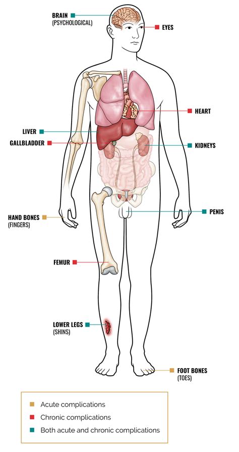 Sickle Cell Symptoms & Complications