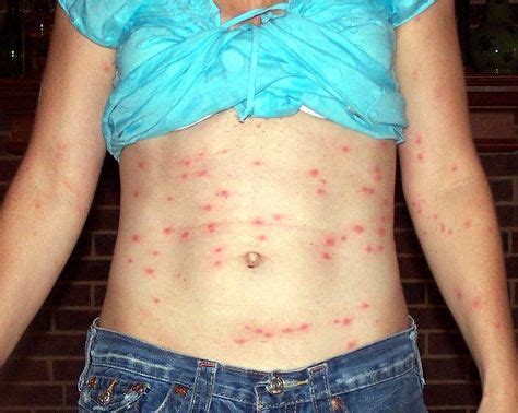 chiggers rash | Chiggers | Bed bug bites, Chigger repellant, Home remedies