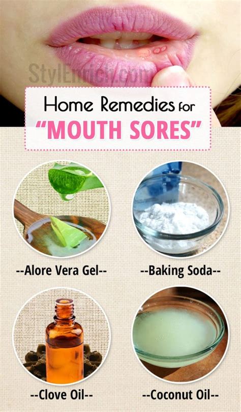 Home Remedies for Mouth Sores or Canker Sores