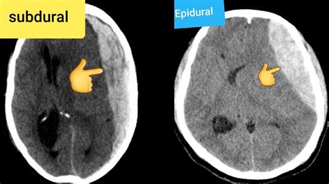 Epidural Hematoma Ct Head