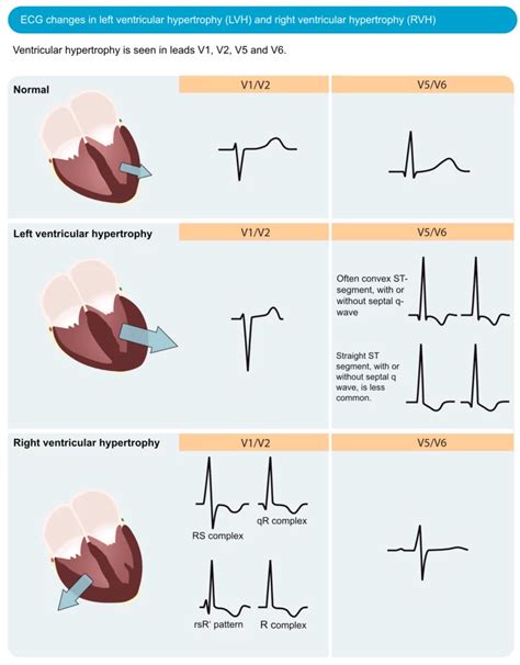 ECG in left ventricular hypertrophy (LVH): criteria and implications ...