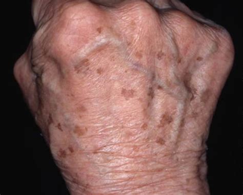 Age Spots - Causes, How To Get Rid, Cream & Treatment