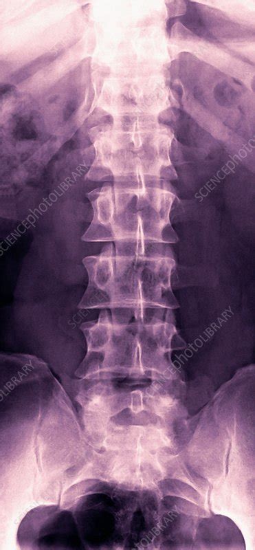 Normal lumbar spine, X-ray - Stock Image - F001/2975 - Science Photo ...