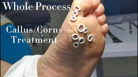 Callus#2 How to treat corns and calluses. Corn treatment and callus ...