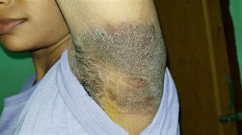 ATYPICAL TINEA CRURIS et CORPORIS