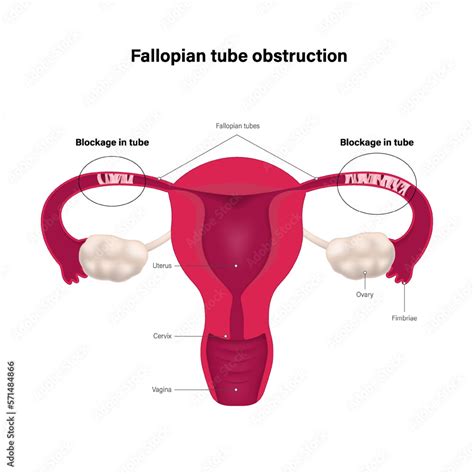 Fallopian tube obstruction. Block fallopian tube. Uterus and uterine ...