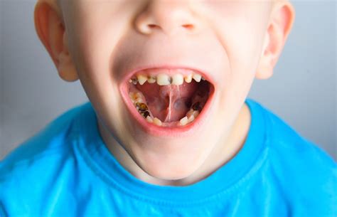 Kids’ teeth – from six months to six years | Health24