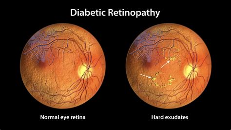 Diabetic Eye Exam: What to Expect, Costs, and How Often