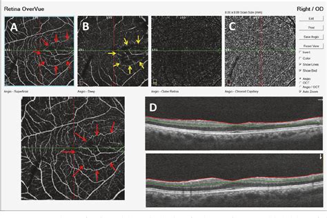 Figure 1 from Cilioretinal Artery Occlusion Combined with Central ...