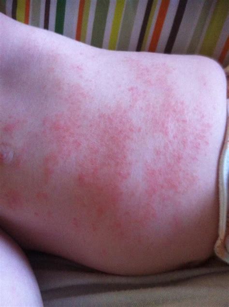 Food Allergy Skin Rash Baby