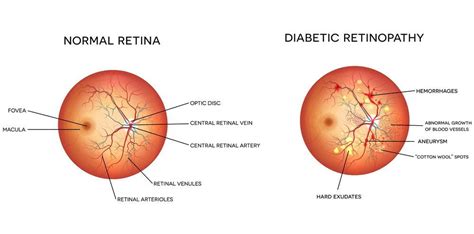 Stages of Diabetic Retinopathy