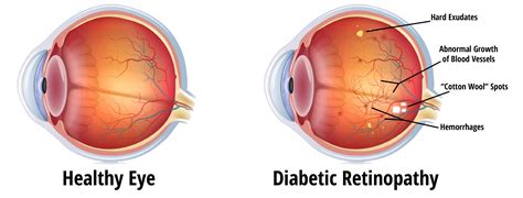 Diabetic Retinopathy – EyeCare Associates of South Tulsa