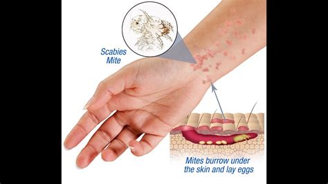 Scabies Types Causes Symptoms Treatment Ushc | The Best Porn Website