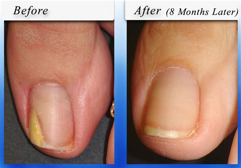 Yellow Toenails - Does Toenail Fungus Always Cause It? | SteriShoe Blog ...