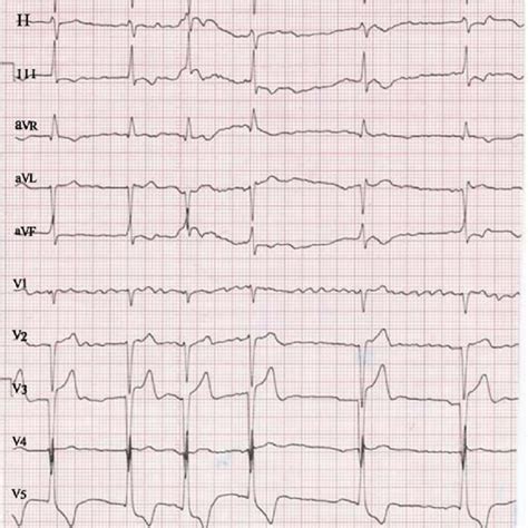 ECG showing atrial fibrillation and LVH and a gross increase in ...