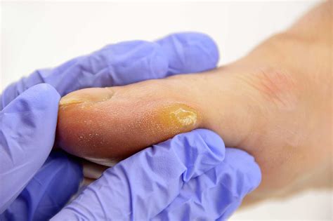 Corns & Callus Treatment in Farnham, Surey | Foot Hard Skin Removal