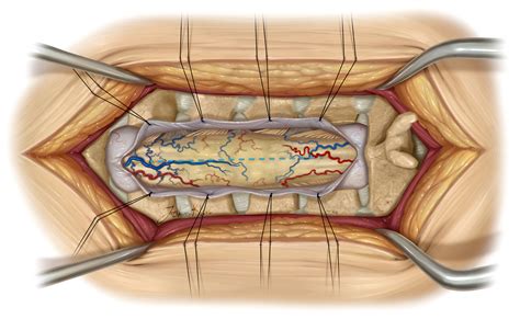 Spinal Cord Tumor