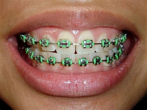 √ Braces Color Teal