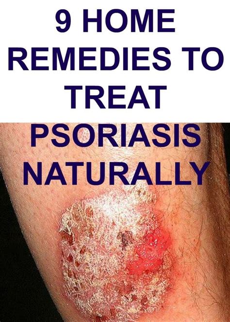 9 HOME REMEDIES TO TREAT PSORIASIS NATURALLY | Treat psoriasis, Plaque ...