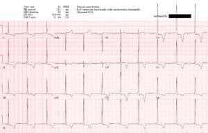 EM cases | ECG cases 13: LVH + occlusion MI