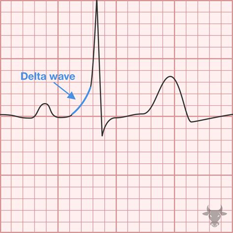 Ventricular Pre-excitation | ECG Stampede