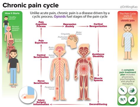 Chronic pain cycle – Within Normal Limits of Reason – Medium