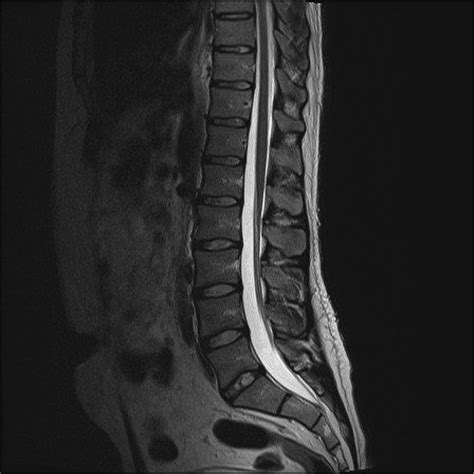 Lumbar Spine Mri Mri Scan Images Lumbar Spine Spine Anatomy Mri ...