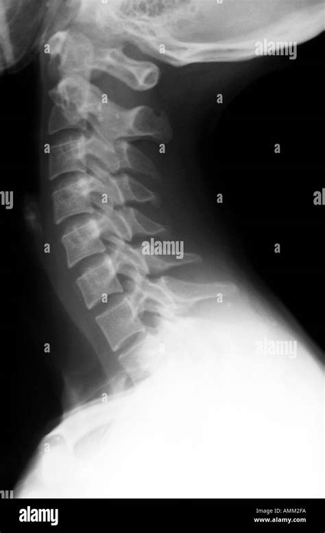 X ray normal cervical spine Stock Photo - Alamy