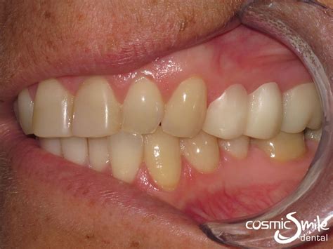 Snap on Smile Before and After - Cosmic Smile Dental