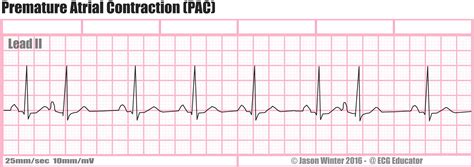 Premature Atrial Complex